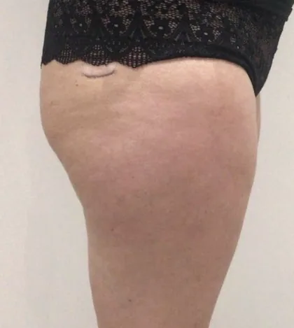 Female patient outer thigh and hip photographed before body contouring at The Hampton Clinic