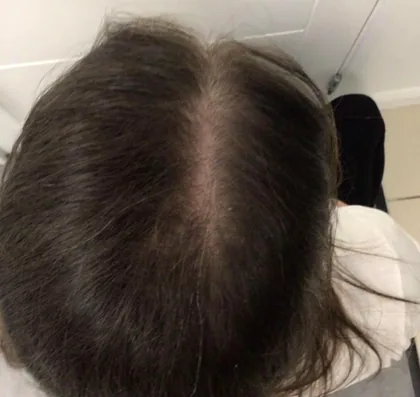 The same patient with a narrower parting and improved density after treatment