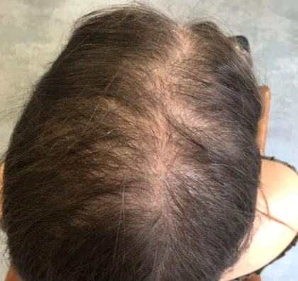 Female patient mid scalp with a wide visible parting before treatment
