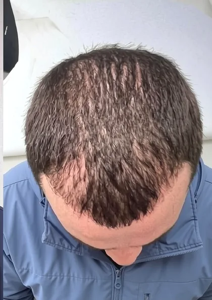 The same patient after treatment, with noticeably denser frontal coverage