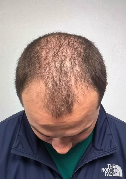 Male patient frontal hairline showing thinning and visible scalp before treatment