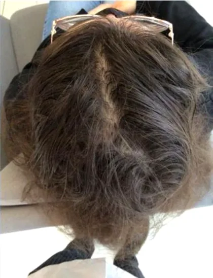 The same patient after treatment, with the parting narrowed and density restored