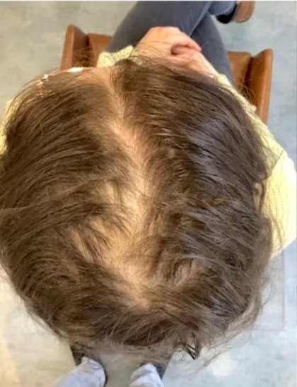 Female patient crown showing a widened parting and diffuse thinning before treatment
