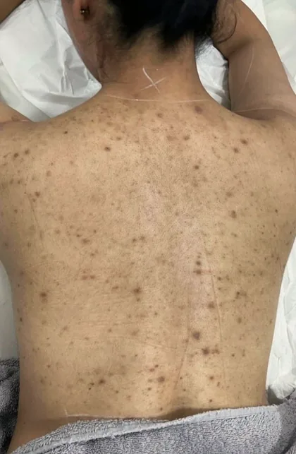 A female patient's back before a course of laser hair removal at The Hampton Clinic, Bristol