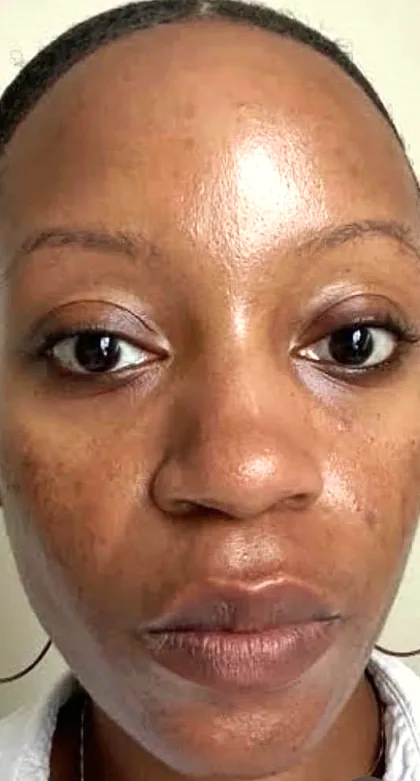The same patient after a pigmentation plan, with a more even tone across the cheeks