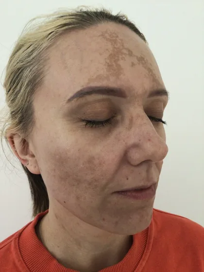 Forehead melasma seen from the right before treatment, The Hampton Clinic Bristol