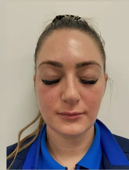 The same patient after a pigmentation plan, with a more even tone