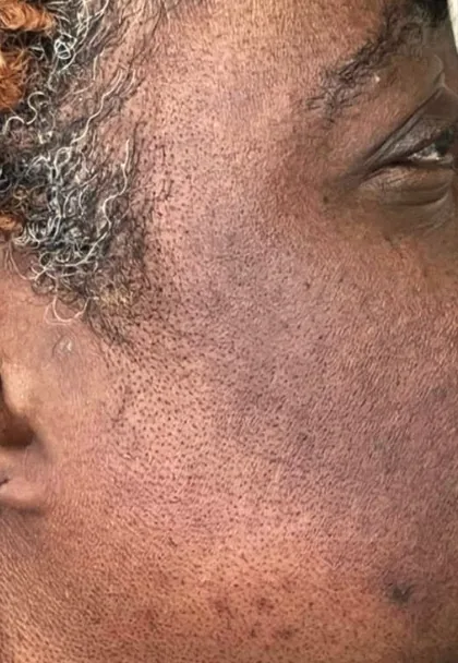 Uneven tone and texture at the temple of a patient with a deeper skin tone before treatment at The Hampton Clinic